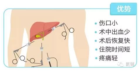 胆囊开腹切除是半麻还是全麻