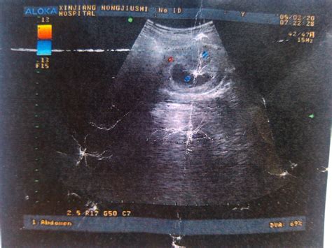 怀孕9周胎儿高清图片