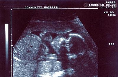 9周的胎儿b超图