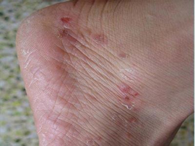 股癣通过性传播吗