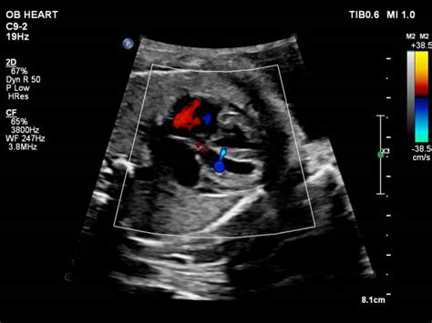 什么情况需要做胎儿心脏超声检查