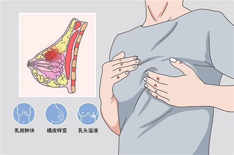 乳房两侧胀痛吃什么药