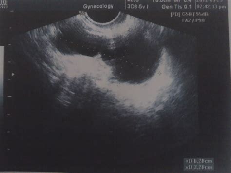 宫腔积液孕早期