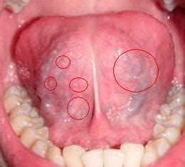 尖锐湿疣会通过马桶传播吗