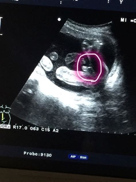 怀孕八周的b超图怎么看