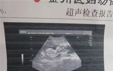 从妊娠纹线可以看出宝宝性别吗?