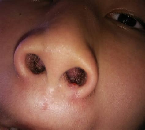 女人鼻癌的前兆