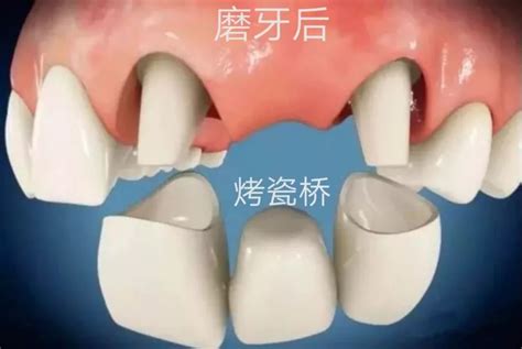 假牙跟活动牙的区别