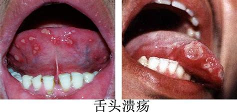 三岁宝宝口腔溃疡是什么原因