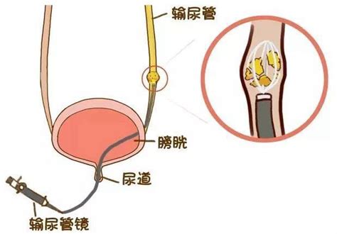 输尿管疼痛位置图