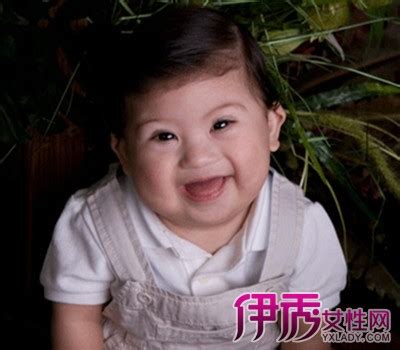 唐氏症宝宝症状