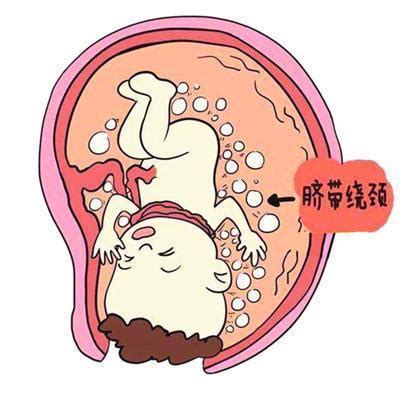 38周胎儿脐带绕颈二周