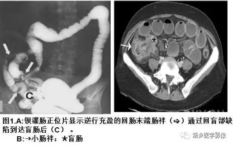 胎儿肠管多宽是扩张