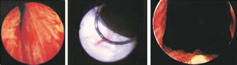 前列腺微创手术的危害