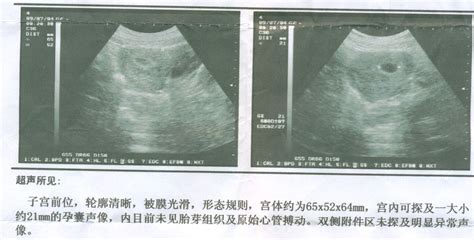 b超显示怀孕8周实际受孕几周