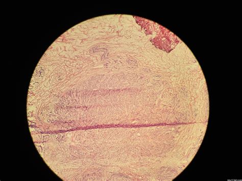 乳房有滑动包块是什么