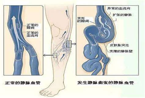 精索静脉曲张会导致短小吗