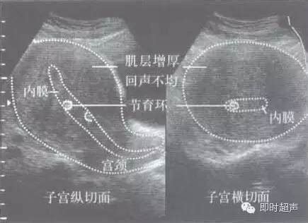 腺肌症怎么怀孕