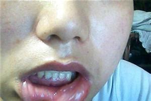嘴唇干裂是什么原因引起的怎么治