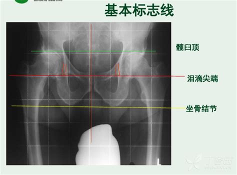 左髋臼内可见结节状高密度影