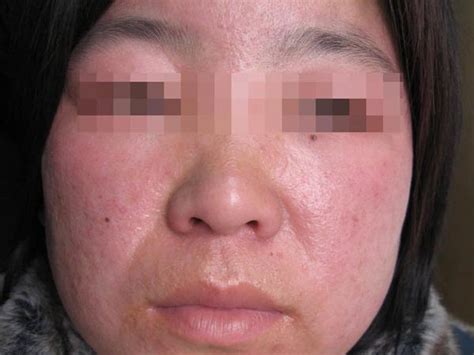 儿童接触性皮炎怎么治疗方法