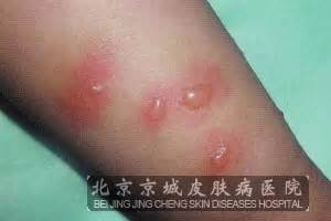 宝宝出荨麻疹的原因