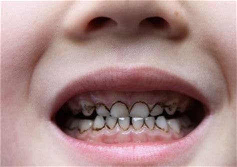 怀孕牙齿出问题是什么原因导致的