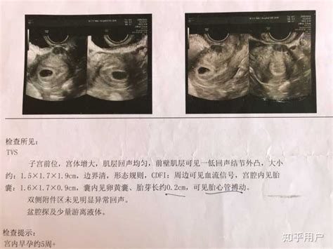 怀孕5周未见胚芽及原始心管搏动