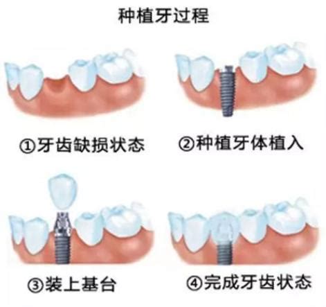 种植牙的手术费用是多少钱