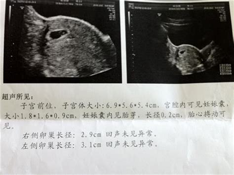 怀孕几个月做胎心监测