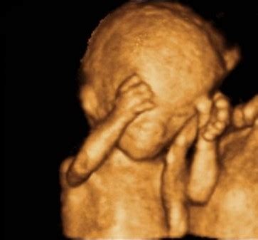 孕期怎么知道胎儿畸形