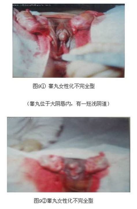 假两性畸形女孩是真是假