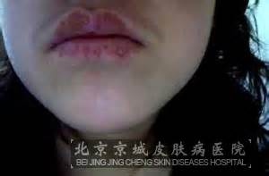 宝宝口角炎有什么症状