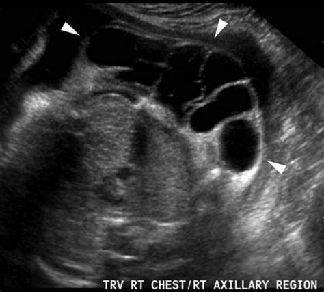 胎儿多囊肾超声表现