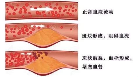 血管堵塞最怕六种食物