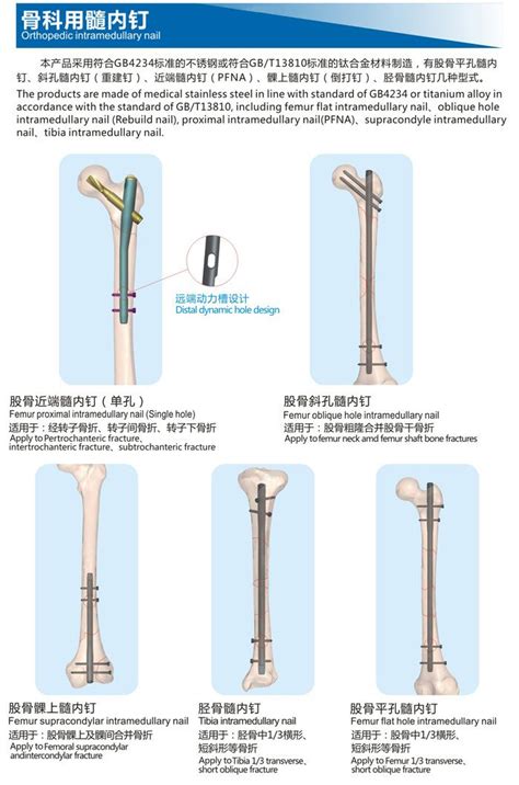 大腿骨折髓内钉固定多久可以走路