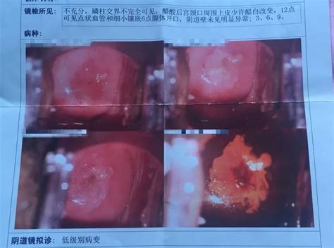 6个月引产子宫要开几指