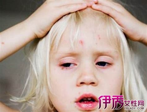 ​孩子起风疹是什么引起的
