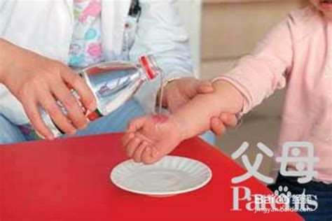 割伤和擦伤的护理方法