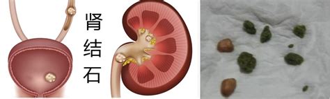 肾结石最怕三种运动
