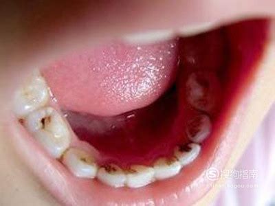 8岁儿童蛀牙需要拔牙吗