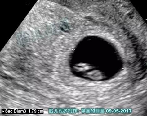 如何根据孕囊大小判断胎儿大小