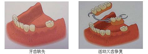 固定假牙是怎么固定的
