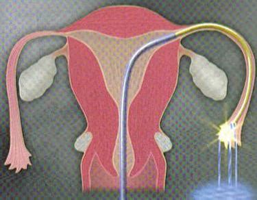 女人输卵管不孕的原因