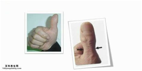 杵状指最常见的疾病是