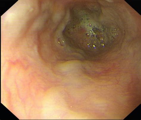一招缓解急性胃炎