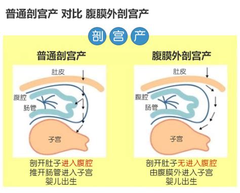 剖宫产后多久可以跳绳