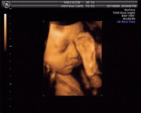 胎儿偏小2周彩超图片