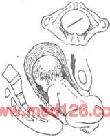 孕30周臀位矫正视频