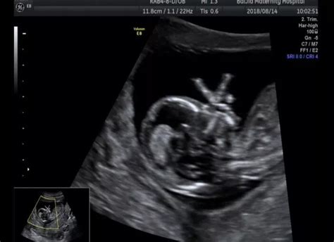 孕14周胎儿彩超图片